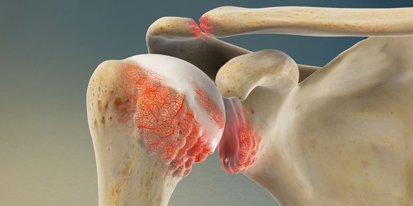 shoulder-arthritis