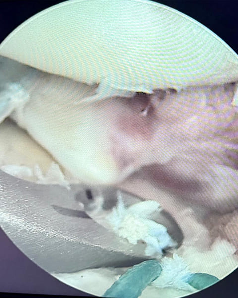 Shoulder Dislocation