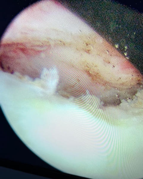 Shoulder Dislocation