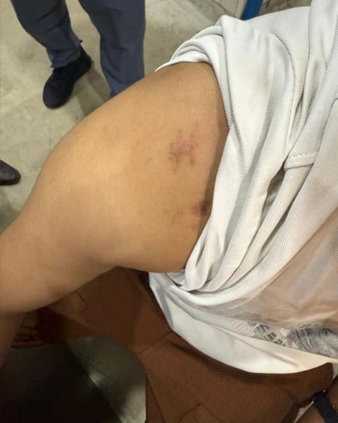 Shoulder Dislocation