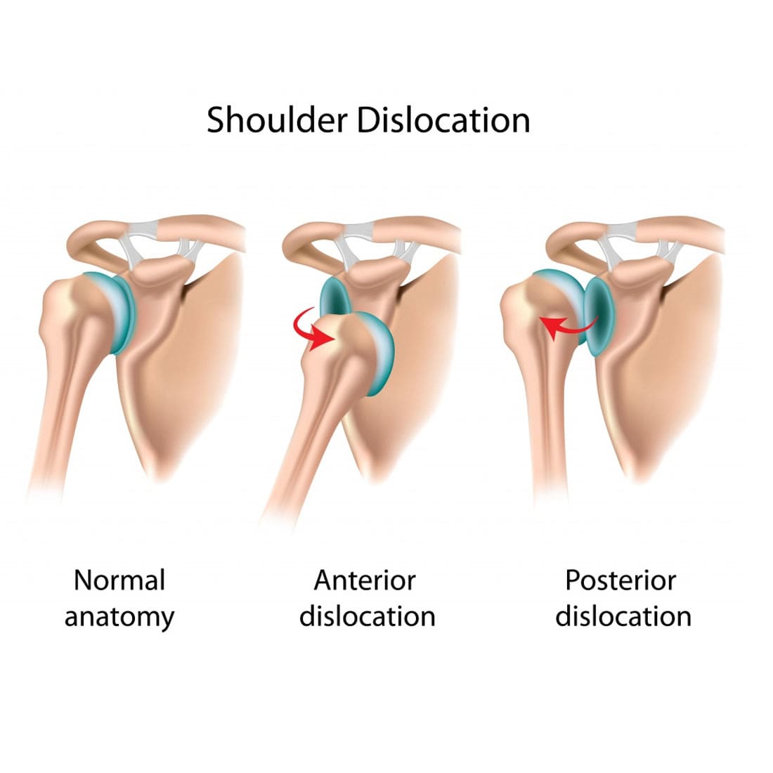 shoulder-dislocation
